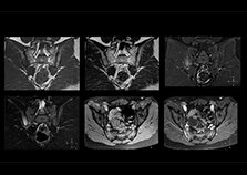clinical cases 2 sacroiliac joint on multiva