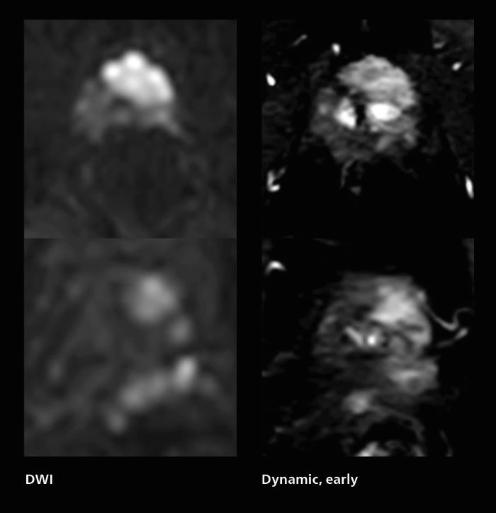 Fast prostate cancer MRI images with motion-free show much better quality than T2W without motion-free, almost similar scan time, mobile two