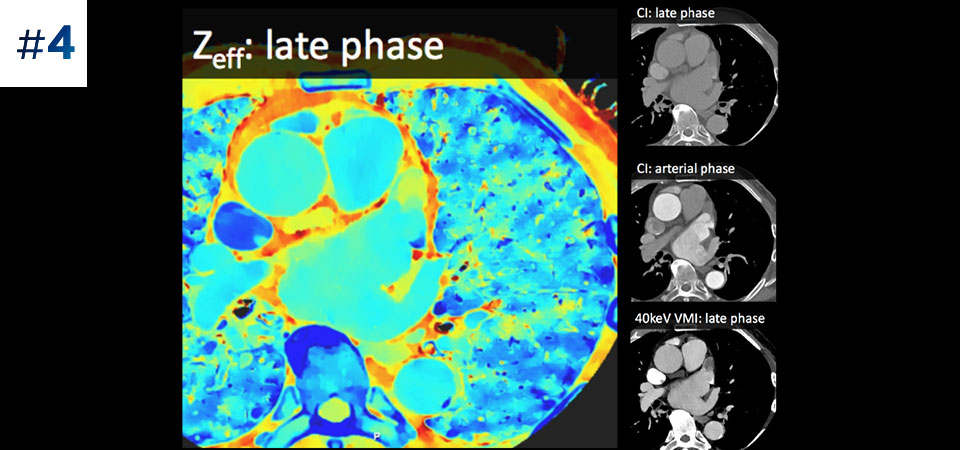 Apendicele atrial st&acirc;ng