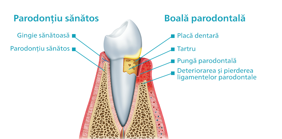 parodontiu philips sonicare
