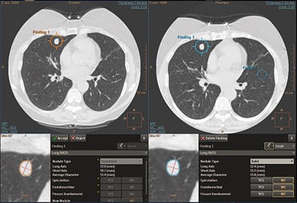 ct-lung-nodule-assessment